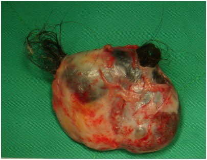 畸胎瘤(內有毛髮,清晰可見)