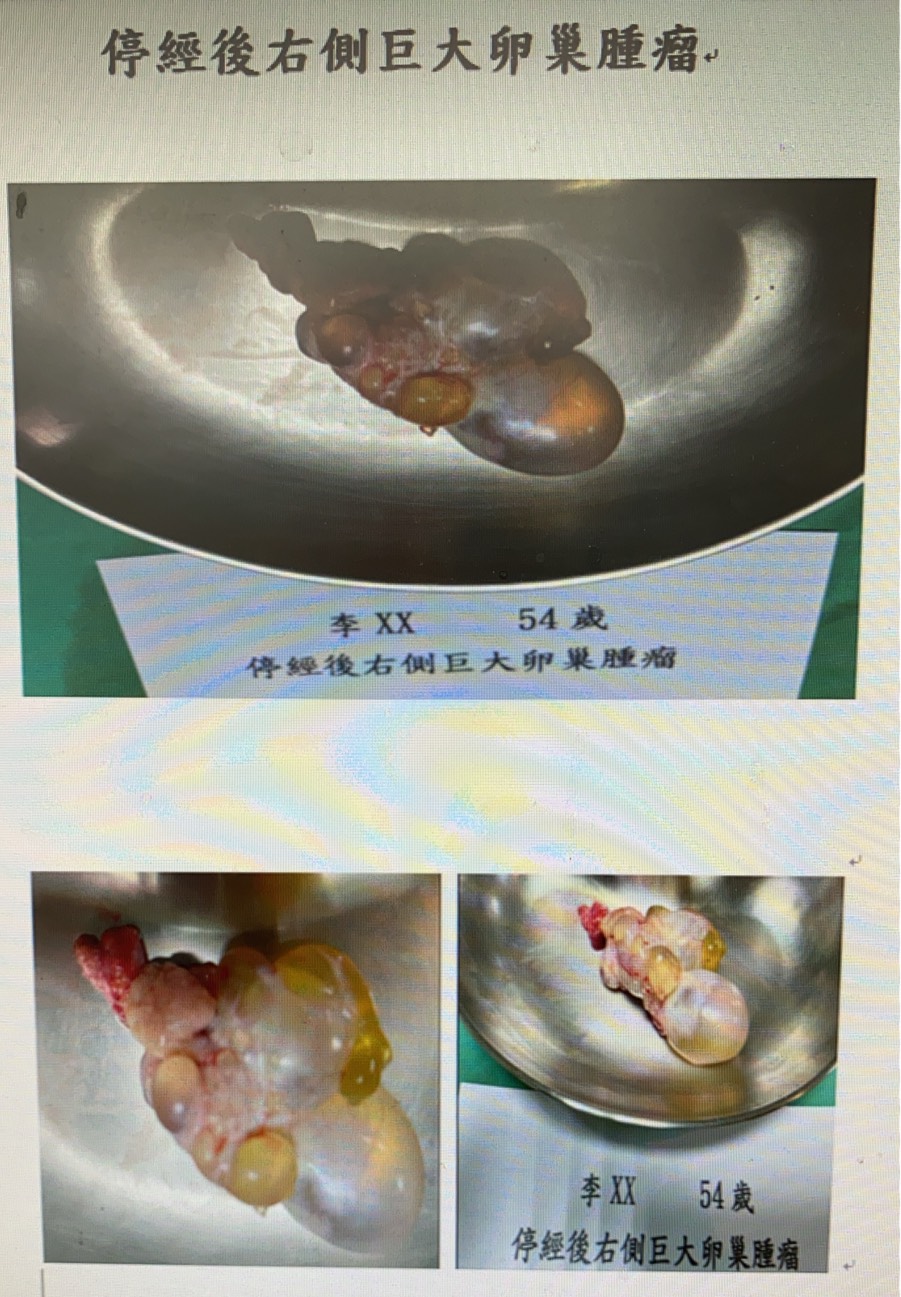停經後右側巨大卵巢腫瘤